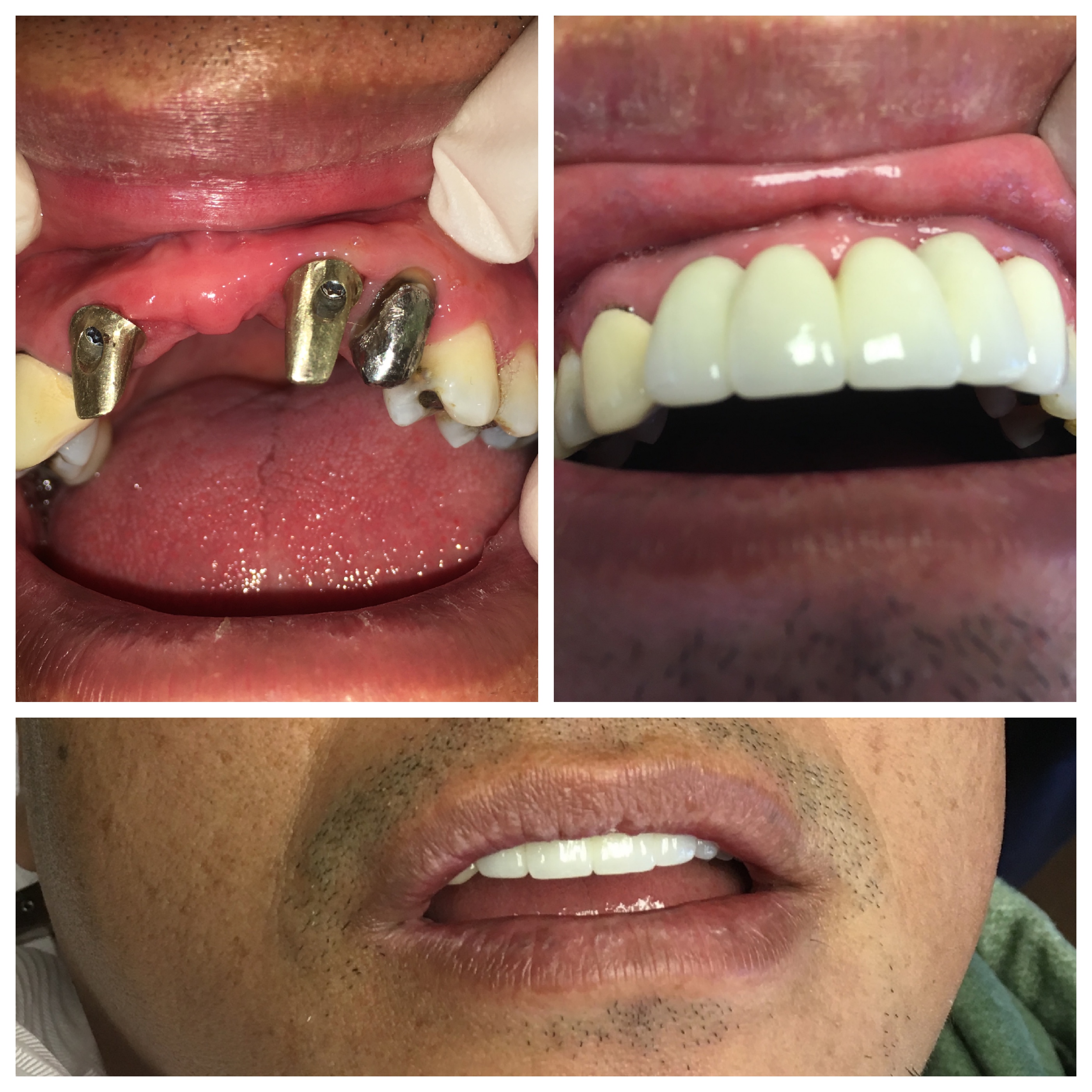 Implant