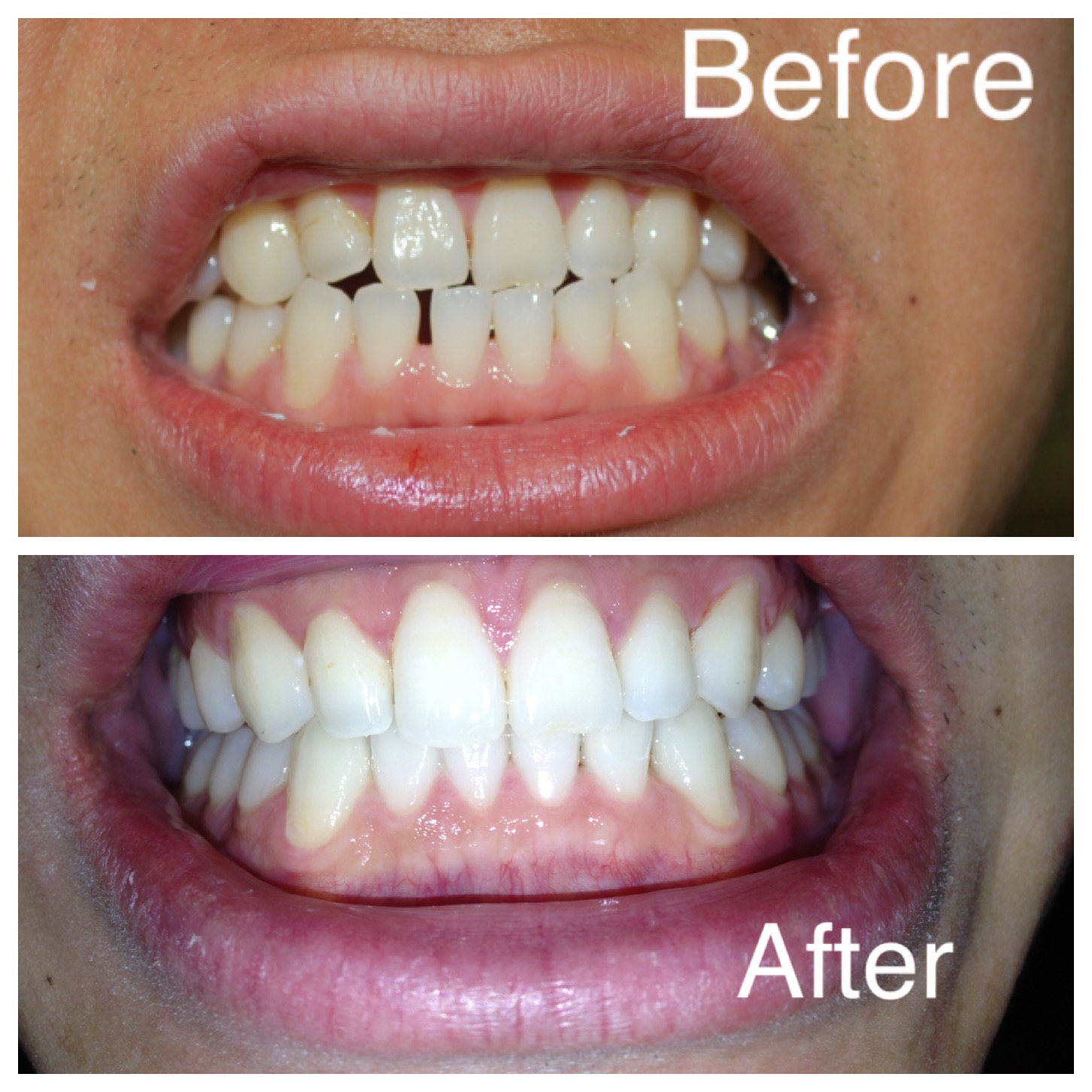 Invisalign and Zoom whitening