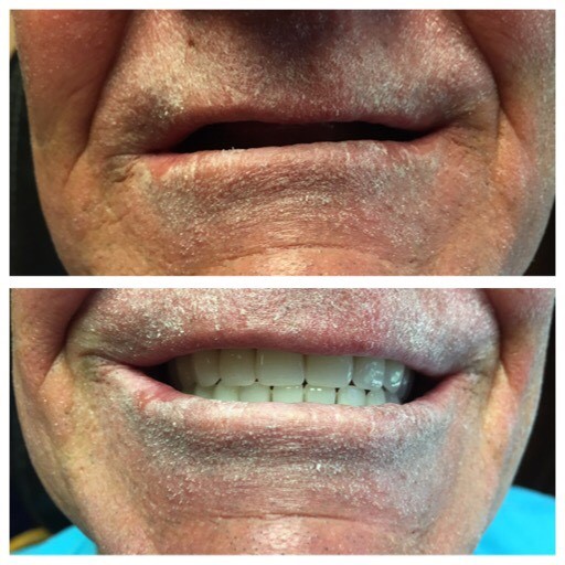 Complete Dentures