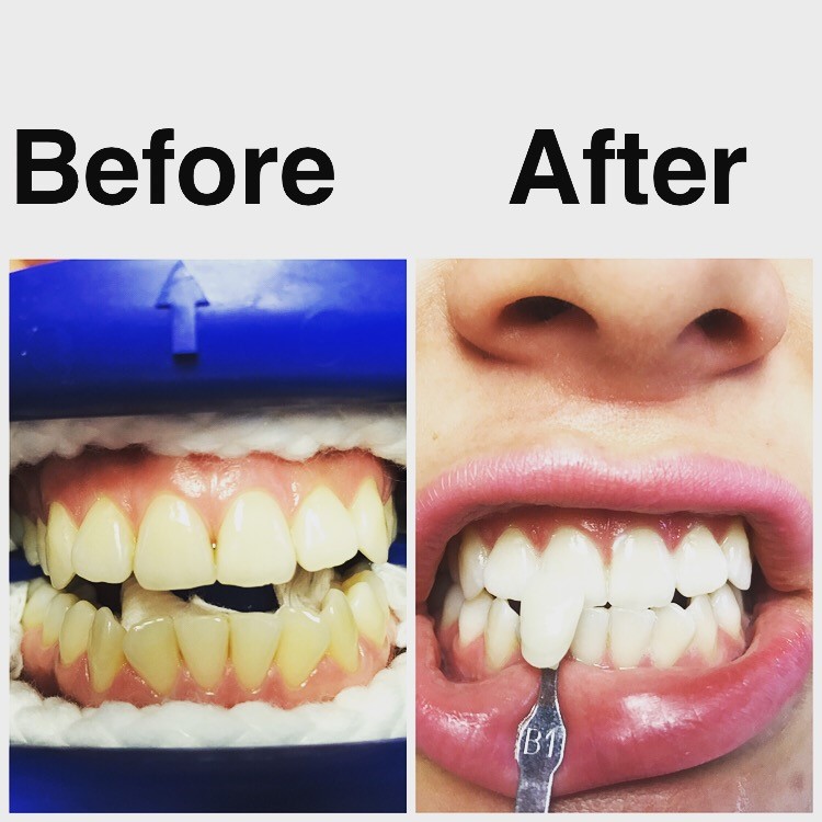 Zoom whitening